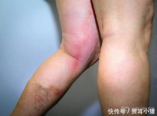 金鸡独立|血栓最怕你做3个动作,坚持做下去,你的血管干干净净