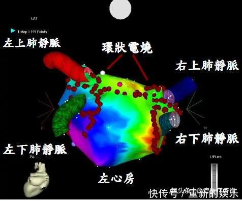 你不可忽略的心律不整-心房颤动