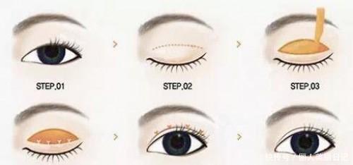 重睑术是什么?俗称割双眼皮,双眼皮手术