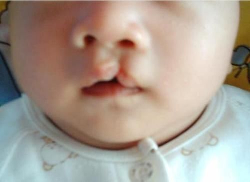 张女士|产妇生出“兔唇”宝宝,谎称孕期吃了兔肉,医生的话让她羞愧不已