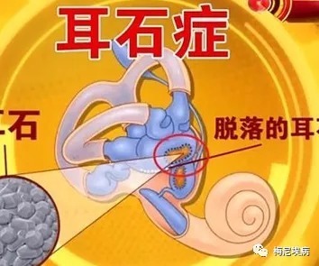 疾病|耳石症是一种什么疾病?有哪些治疗方法?