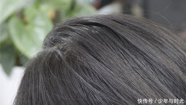 头皮屑是从哪里来的，为什么有些人头皮屑多？