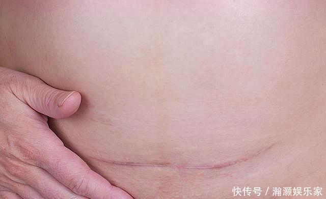 剖腹产|“顺产肯定比剖腹产好”错!孕妈别被这样的鄙视链绑架了