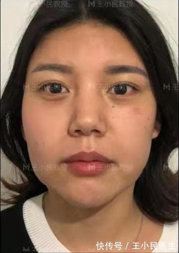 王小民 面部提升王小民教授:小拉皮定格青春,30岁仍然如花似玉!
