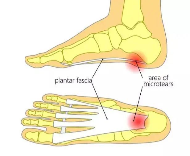 疼痛|脚疼是怎么回事？带你揭秘这几个不同部位疼痛的真相！