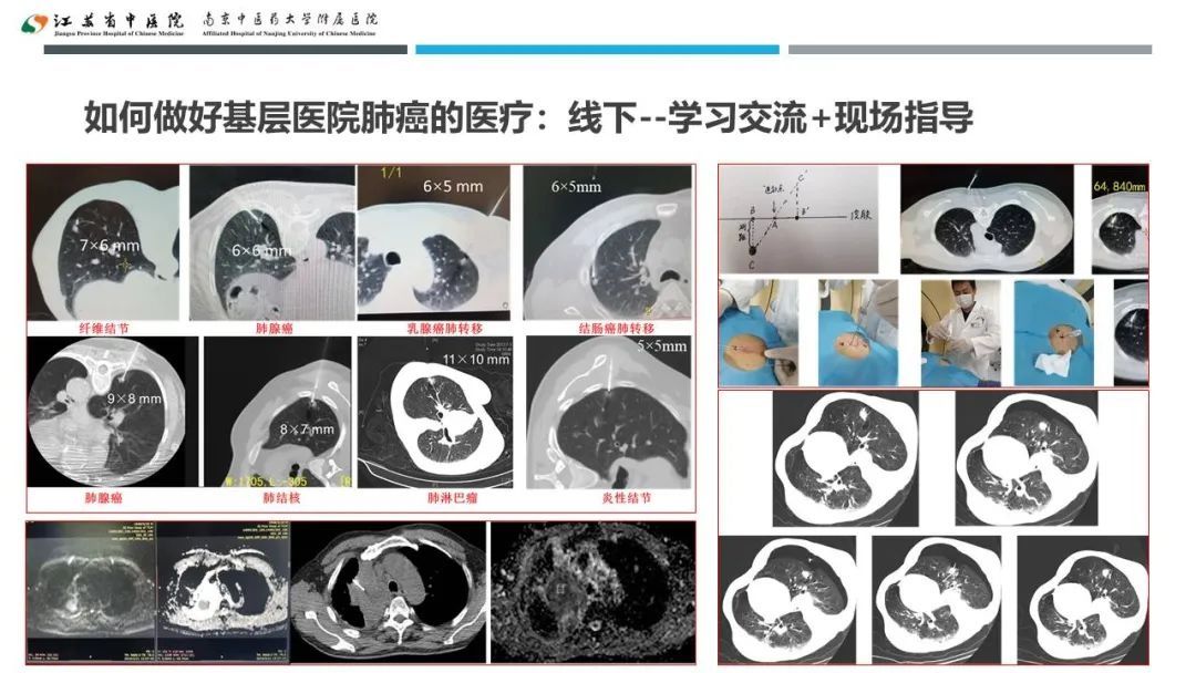 蔡婧|共谋江苏省基层医院肺癌未来发展之路