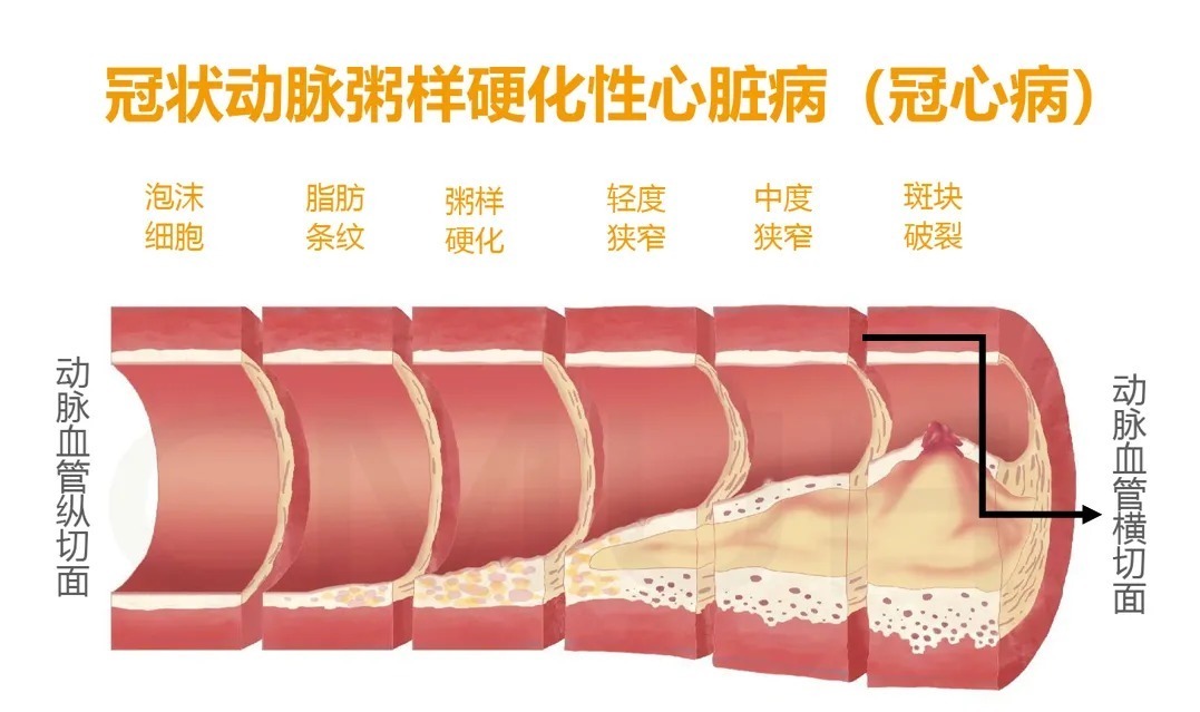 动脉粥样硬化性心血管疾病|动脉粥样硬化的日常防护