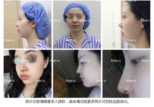 鼻假体|韩啸弟子团王召东详谈鼻假体对于鼻型塑造的决定性要求