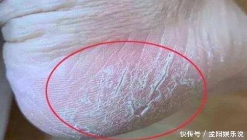 胰岛素抵抗|肝不好,脚部会有3种异常,若你全中,可能是肝“撑不住了”