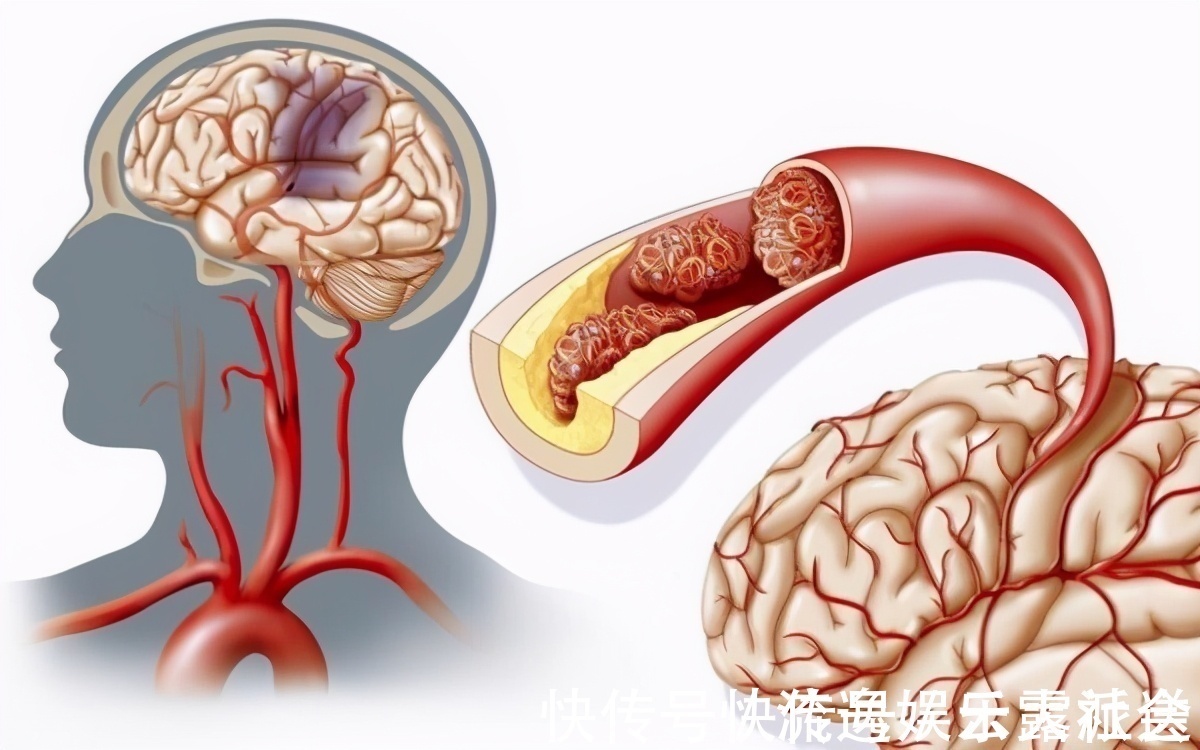 脂质|吃一回相当于吃10斤糖，许多人经常拿来炒菜，血脂怎么会降