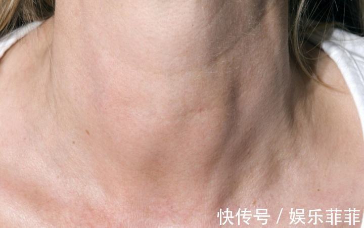氰化物|為何''甲狀腺癌''越來越多4種食物一定要少吃
