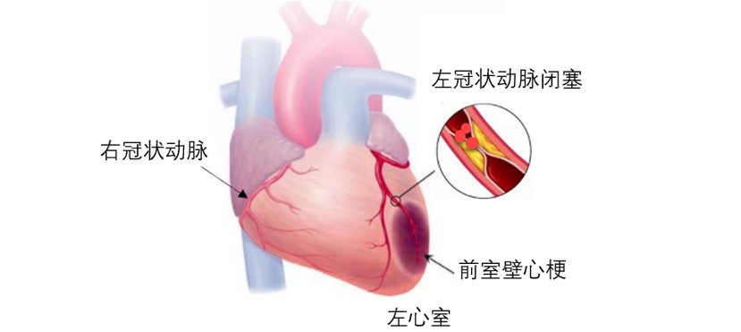 肠溶片|阿司匹林、硝酸甘油、速效救心丸，急救时用哪种？