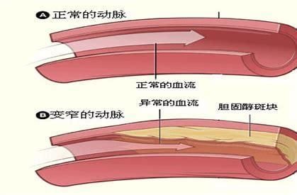 中老年人|中老年人颈动脉斑块，吃他汀类药物可以消失吗？医生为您讲清楚