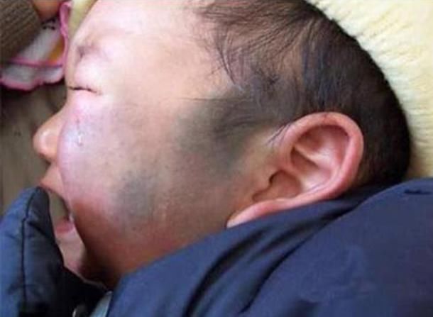 小孩|孕期若常做3件事,或会增加胎儿长胎记的概率,孕妈不妨了解