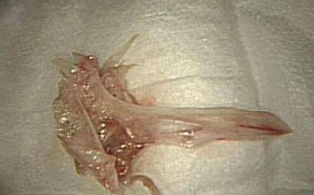 幕后黑手|男孩腹痛干呕,查出胃里有团“胶”,幕后黑手是想不到的健康食品