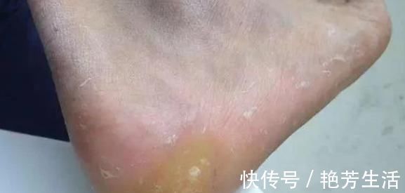 疾病|脚上长“茧子”和疾病有关?若脚上出现4种茧子,一定要留意了!