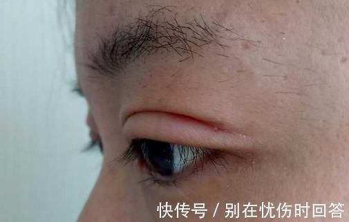 瘢痕 双眼皮术后出现肉条的不同原因和修复方法