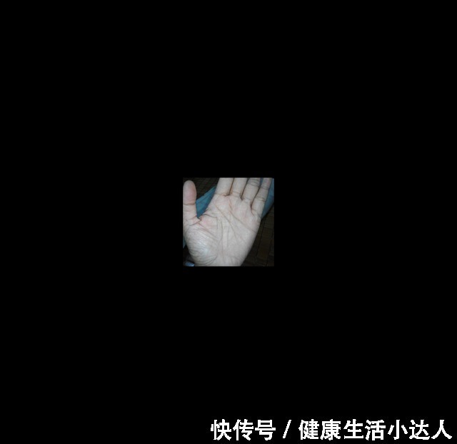 食物|血脂高,“手”知道,若手部出现这5个表现,赶紧查一下血脂