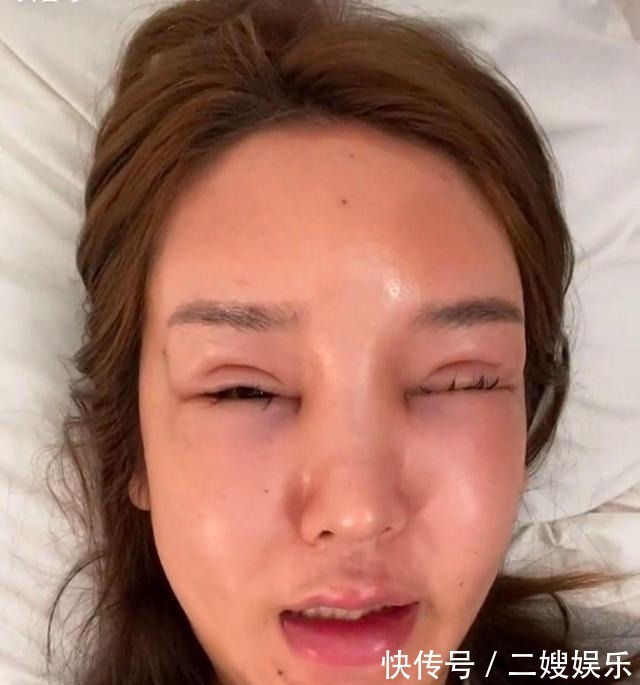 东北女孩 8年的整形手术花费了100多万,光额头就打了200多支玻尿酸