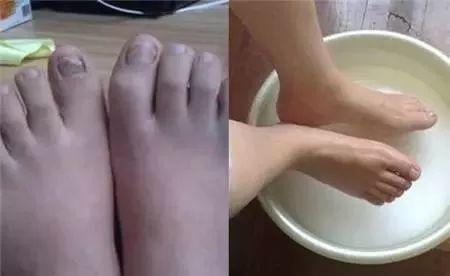 睡眠质量|白醋泡脚太厉害了,到现在才知道,学会你会感谢我!