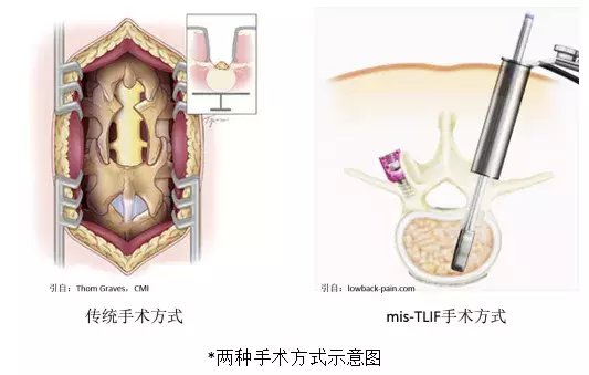 手术|“小切口解决大问题”——微创手术治疗腰椎间盘突出症