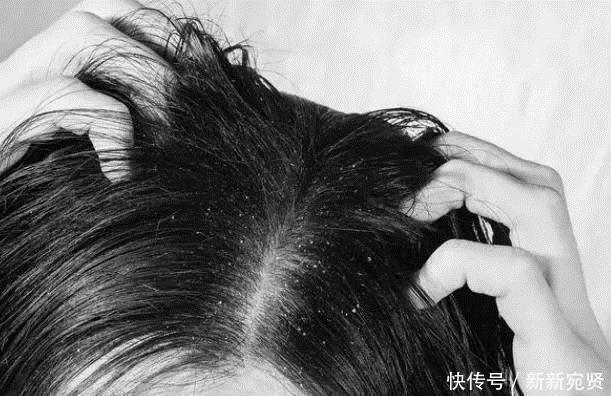 头发上有这“4个现象”,可能是长螨虫了,教你一招,轻松除螨