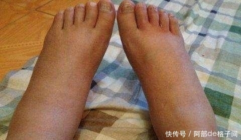 肾衰竭|尿酸高的人注意:若你的身体有这4种表现,可能是肾衰竭找来了
