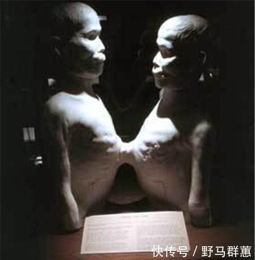 兄弟|这对华裔连体兄弟靠表演成名,娶了一对姐妹,生了22个孩子