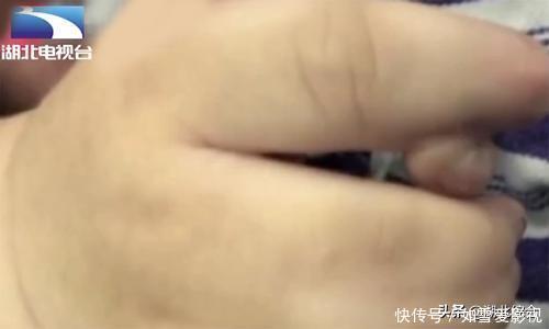 新生儿|罕见!新生儿有25根指头,一看到妈妈的手,医生瞬间明白了
