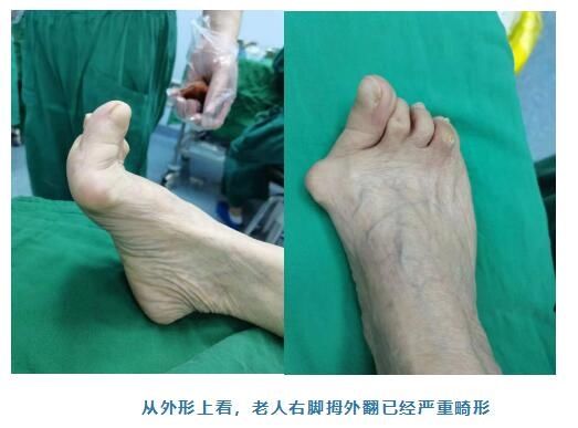 跖趾关节|80岁老人患上“拇外翻”，南医大逸夫医院骨科手术帮老人成功矫正畸形