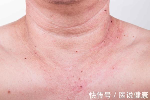 医生|脖子粗不只是肥胖,医生:还可能和这4种疾病的发生有关!