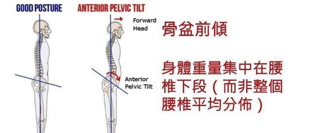 中立|“翘屁股”，我们真的需要它吗骨盆前倾危害大，9个动作纠正它