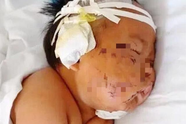 产后抑郁症|5年前因吃奶太用力,被妈妈划成“花猫脸”的男婴,现如今怎样了?