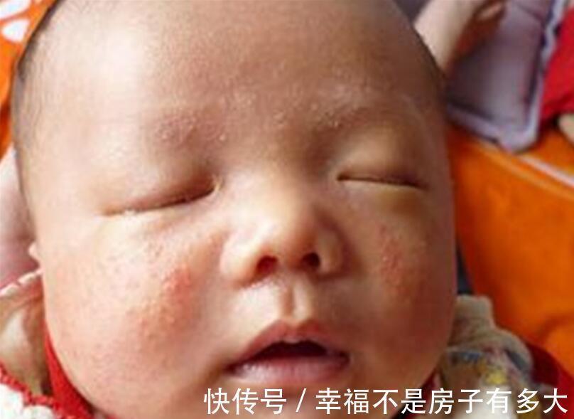 妈妈|母乳妈妈不忌口,宝宝得了湿疹2类食物别再吃了