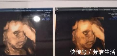 孕妈|四维彩超,孕妈可能更需要“了解”这几件事,否则花钱还伤胎