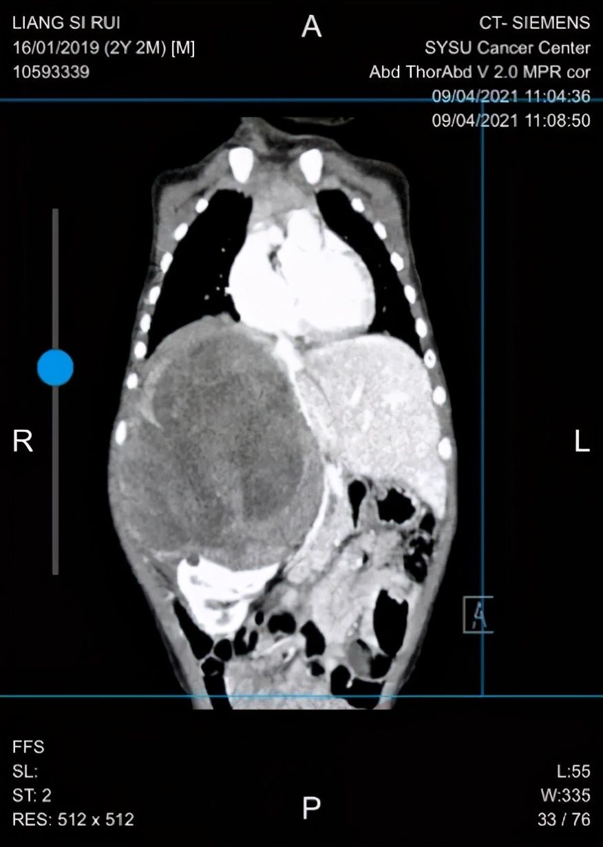 折翼天使们|2岁就查出肿瘤！这些让人心疼的折翼天使们，后来怎么样了？