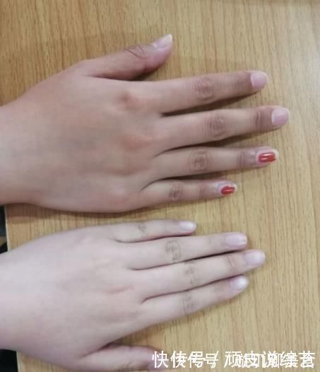 静脉血栓|身体有“血栓”,手脚会告知!一旦手脚出现3种异常,抓紧防血栓