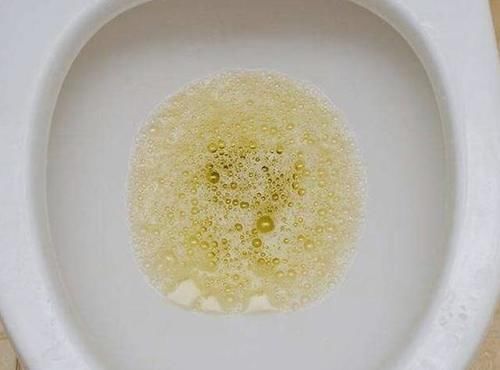蛋白尿|上厕所时,尿液泡沫多,是蛋白尿,肾功不全吗?别傻傻的不懂