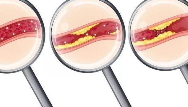 颈部|颈部血管被堵住,身体会有这4个明显症状,很多人还没当回事!