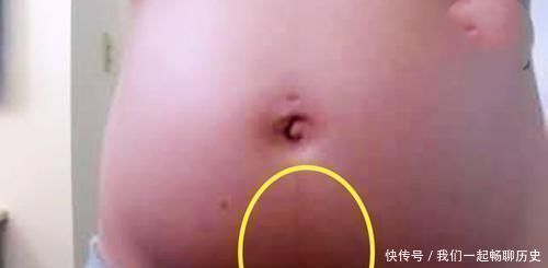 晓芸|怀孕后，孕肚上那条“黑线”能决定生男生女妊娠线功能远不止此