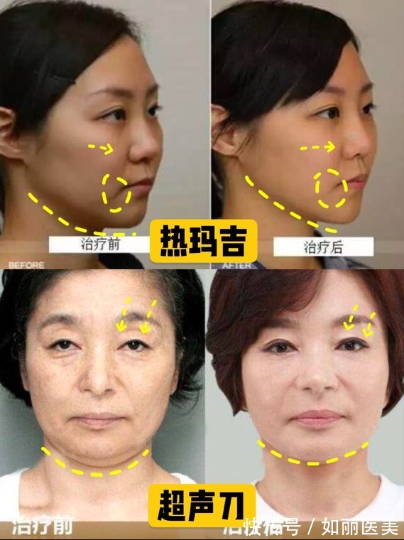 超声提升 热玛吉&超声提升,谁是抗衰NO.1?抗衰选它就对了!