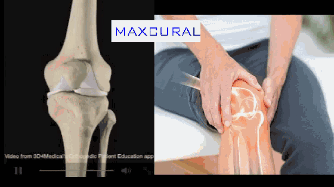 骨关节炎|感觉膝盖发凉？骨科医生教你一个方法“暖”起来