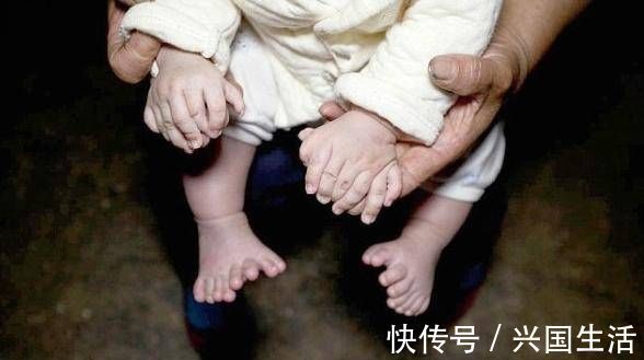 多指畸形|婴儿出生时有30多个手指医生看到了宝妈的手,明白了原因