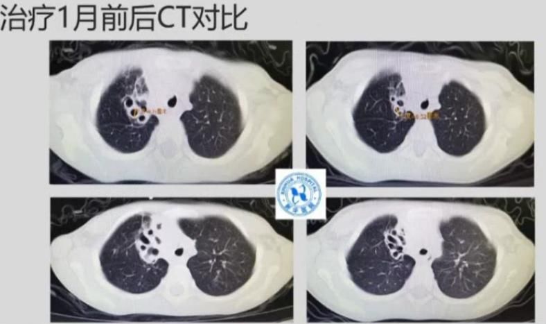 病例|病例分析：儿童肺部感染诊治5大原则，你知道吗？