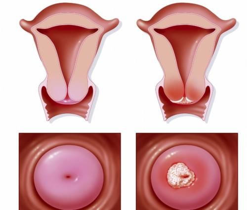 阴茎癌|引发宫颈癌的原因是什么?宫颈癌日常应该注意哪些方面?