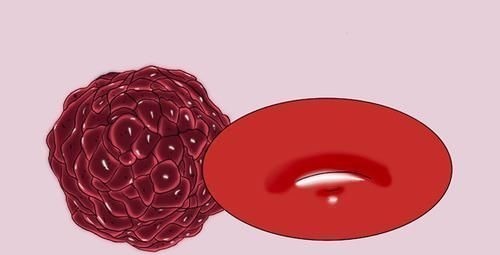 死里逃生|女子肺癌7年,两次发生转移,都死里逃生,她的抗癌方法值得学习