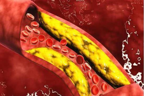 血管|高血脂“克星”公开，避免做这几件事，血管干净通畅