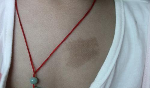 色素|孕期这些不以为然的习惯,或让宝宝带胎记出生,很多孕妈还在犯错