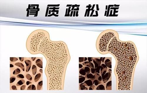 甜食|燕麦是骨质疏松的“发物”？提醒：若想保护骨骼，这3种食物少吃