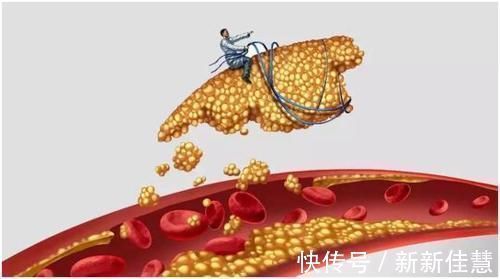 心脑血管|天然“降脂药”在身边,平时吃点,血管年轻10岁,高血脂不攻自破